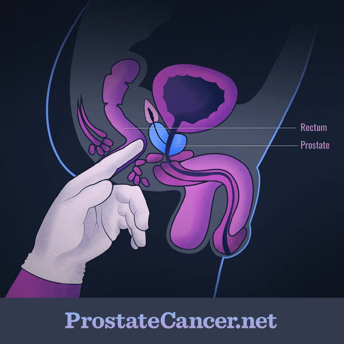 A gloved hand approaches the prostate via the rectum