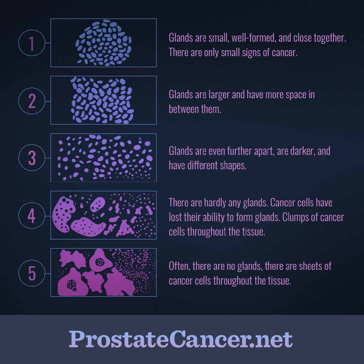 Stadializarea cancerului de prostată | Oncologie | Ghid de boli