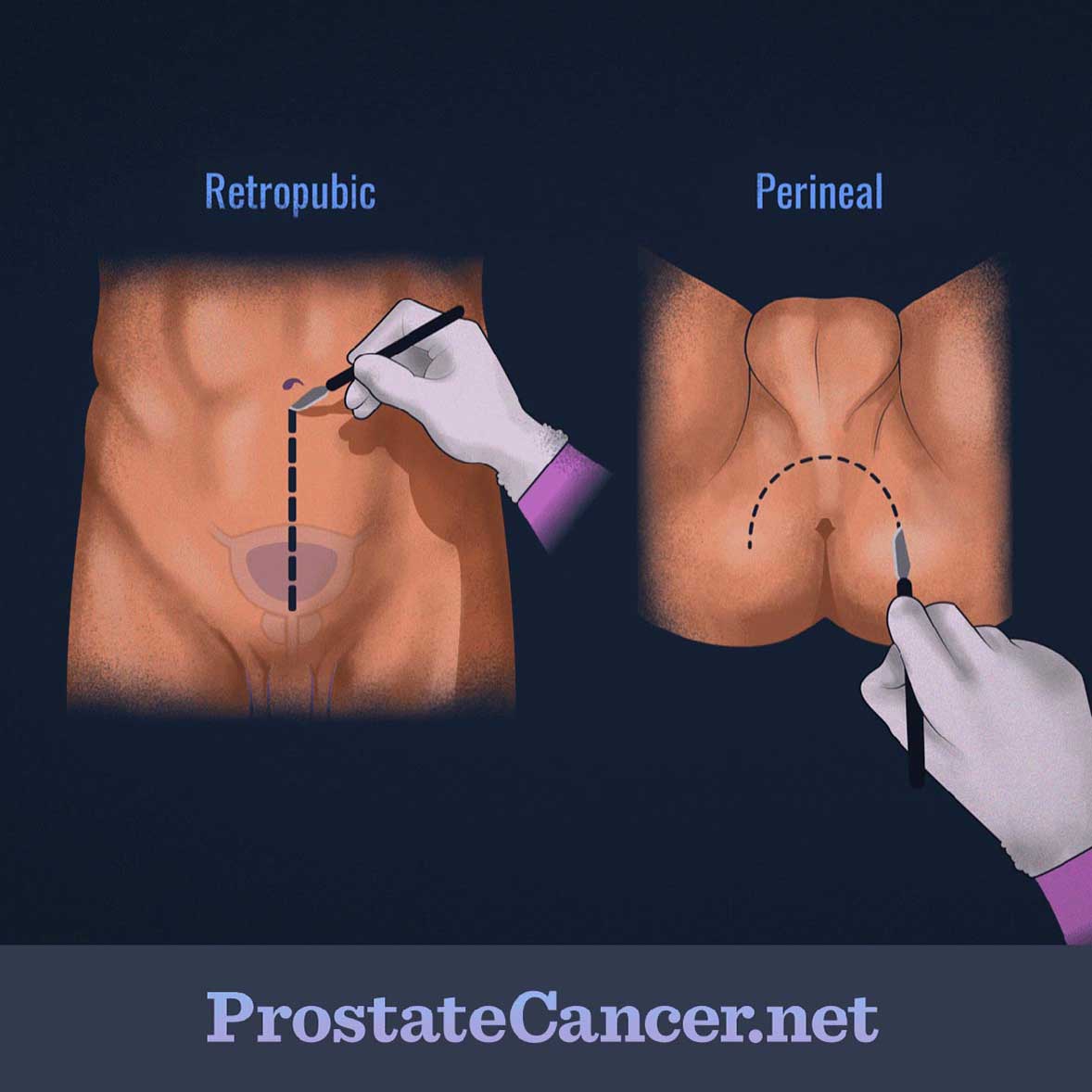 Dotted lines show retropublic incision downward from belly button and perineal incision between anus and scrotum