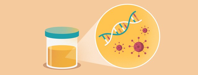 PCA3 Tests Can Reduce Need For Invasive Biopsies image