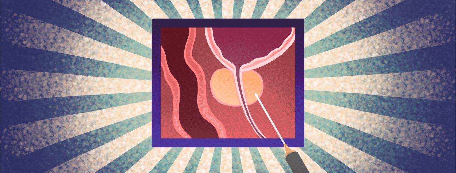 A diagram of a prostate with a biopsy needle.