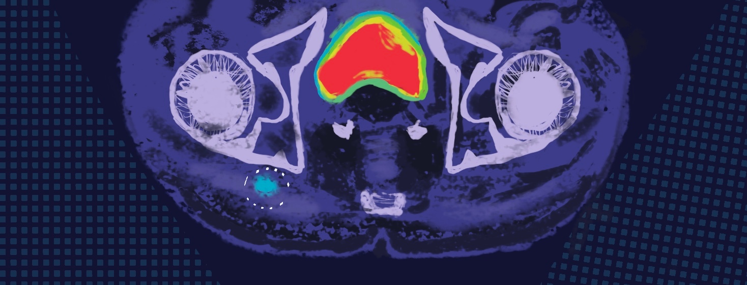 imaging scan for prostate cancer