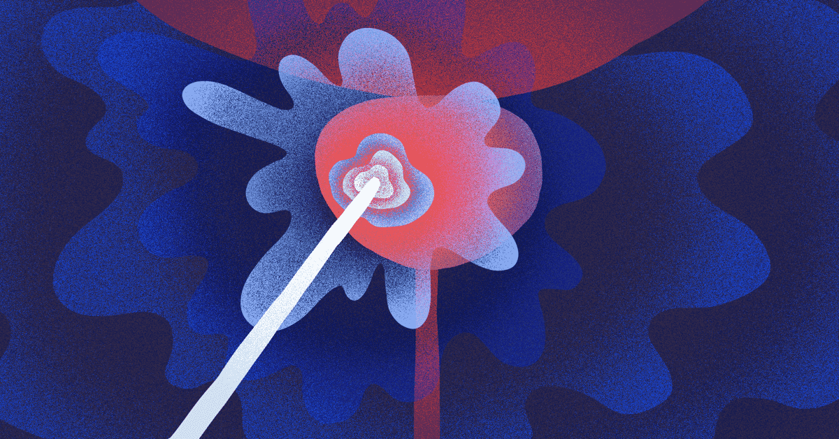Putting the Freeze on Cancer With Cryotherapy image
