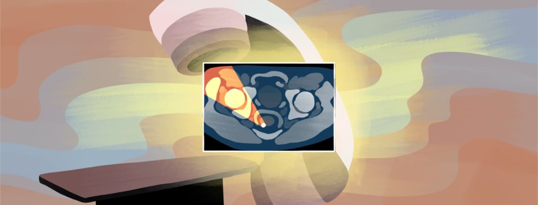 An internal CT scan showing an image of a prostate in front of a linear accelerator radiation therapy machine.