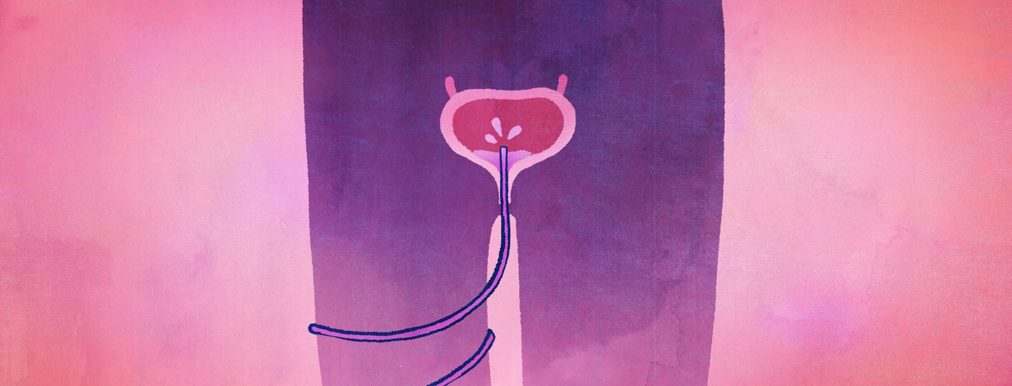 A grungy diagram of a catheter wrapping around the leg of its wearer